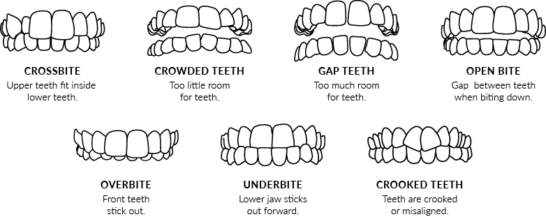 Invisalign Treatable Cases